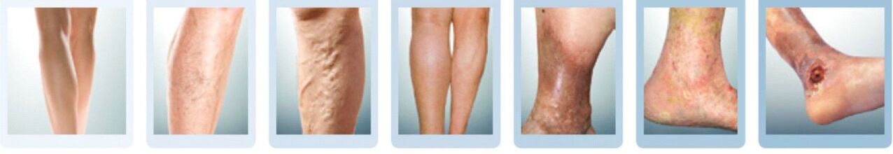 Etapas de desarrollo de las varices de las piernas. 