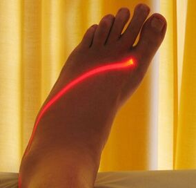Tratamiento con láser de varices en las piernas. 