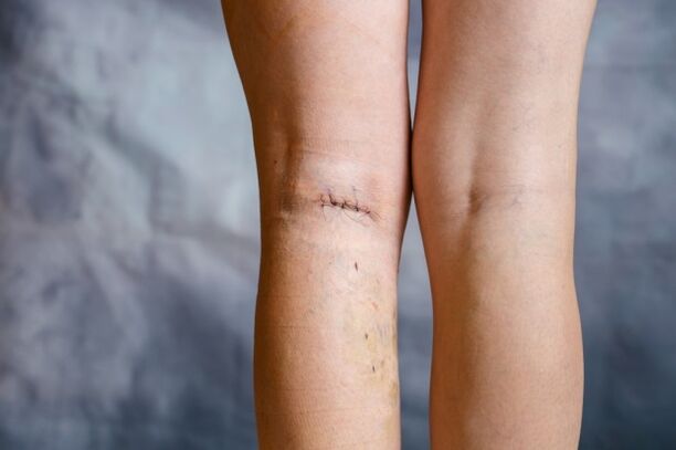 Sutura en la pierna después de la cirugía de varices. 