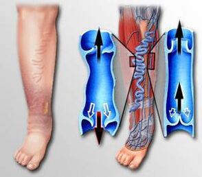 Circulación sanguínea en la pierna con venas varicosas. 