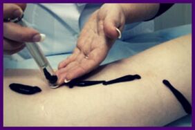 El procedimiento para tratar las venas varicosas con sanguijuelas (hiroterapia)