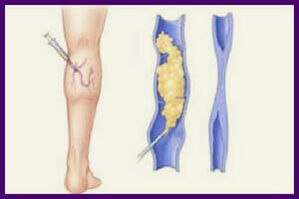 La escleroterapia es una forma popular de deshacerse de las venas varicosas de las piernas