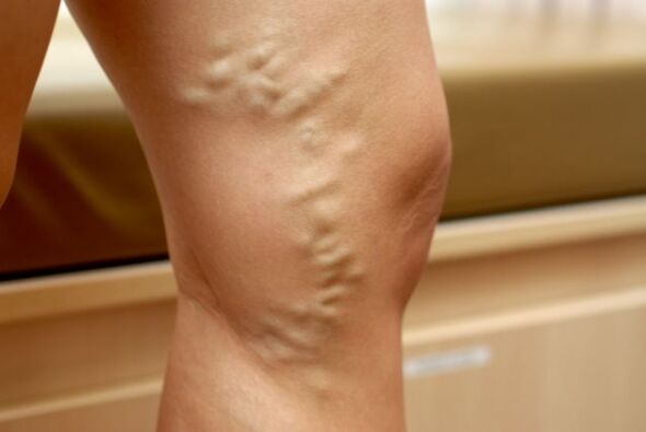 Varices en la pierna con venas varicosas de la pelvis. 