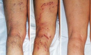 Síntomas de varices en las piernas. 