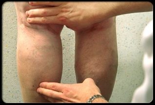 El médico examina las piernas con varices. 