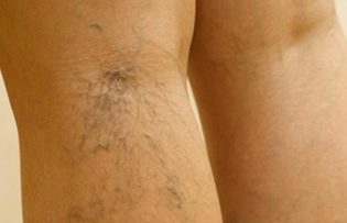 el tratamiento de las venas varicosas en las piernas