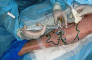 cómo deshacerse de las venas varicosas de la cirugía