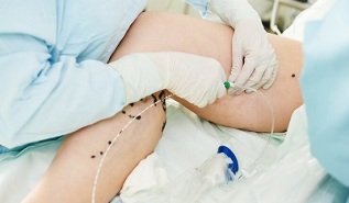Métodos para tratar las varices en las piernas en mujeres. 