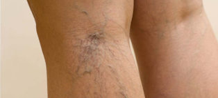 Las venas varicosas en las piernas